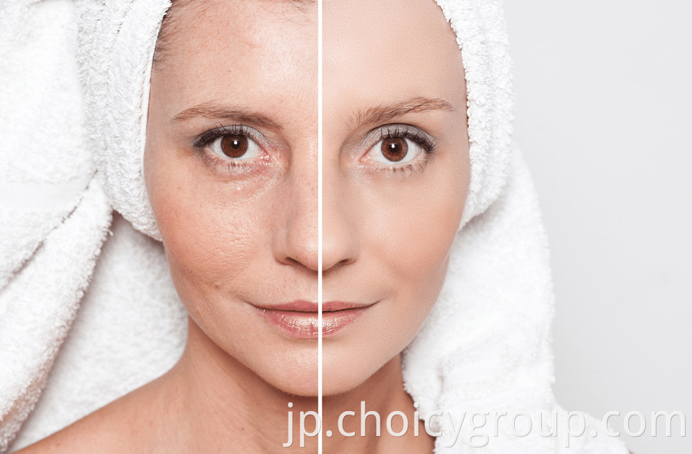 What_Are_the_Benefits_of_RF_Facial_Skin_Tightening